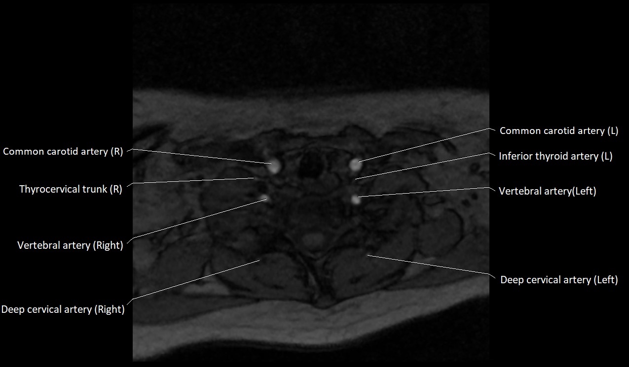 Carotid artery anatomy axial 3T image 61.jpg